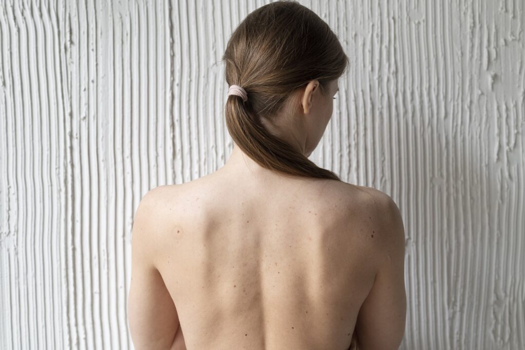 Co pomaga na trądzik na plecach? Podpowiadamy